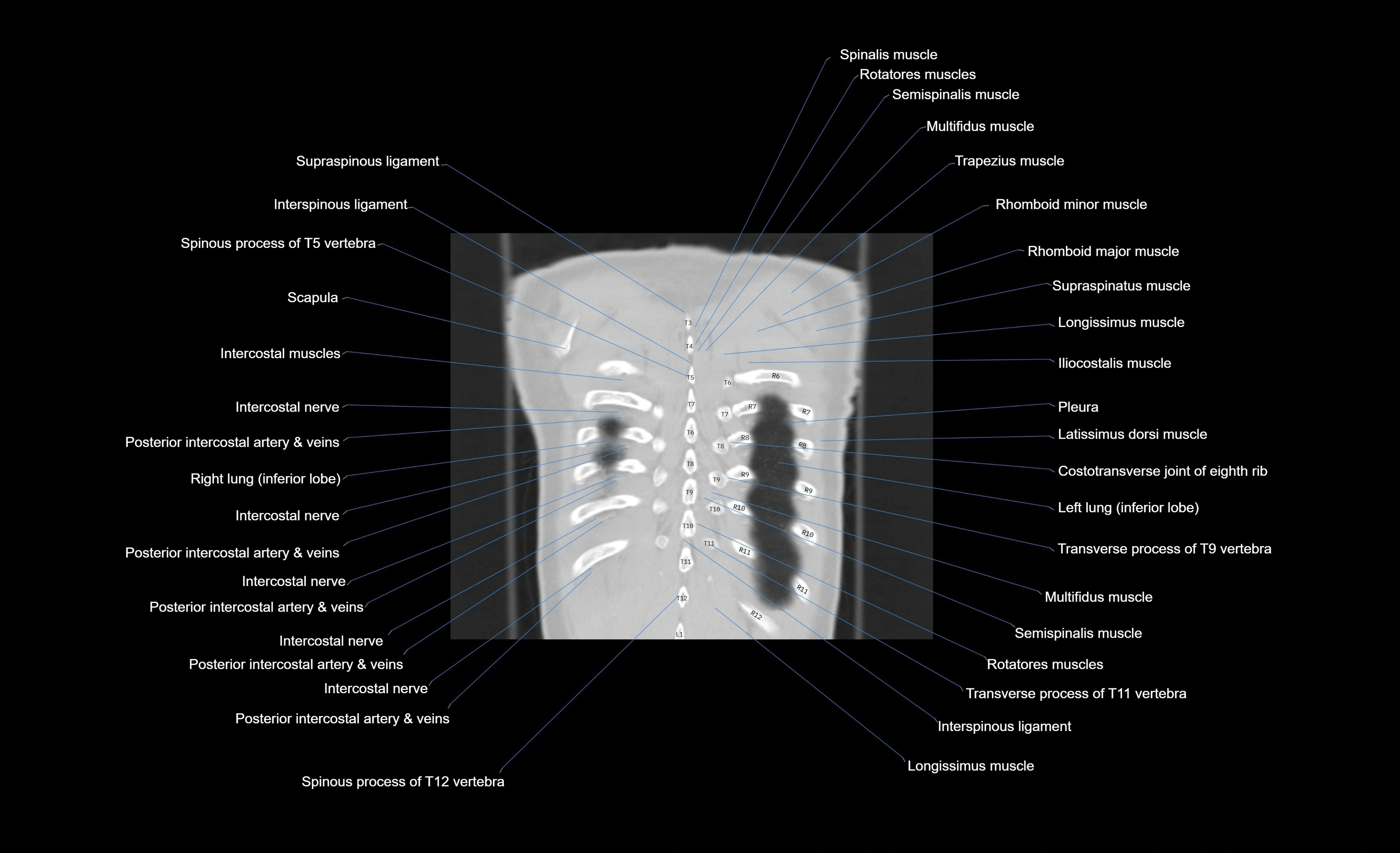 CT chest (thorax) lung window window labelled coronal cross sectional anatomy radiology image-00016.webp